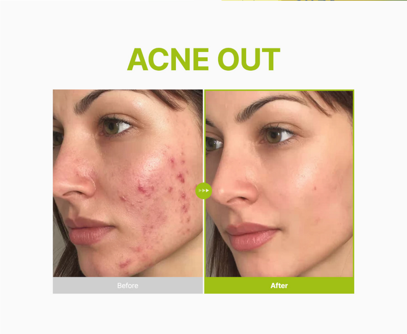 Purito Azelaic Acid 10 Kojic Tea Tree Serum 30 mL