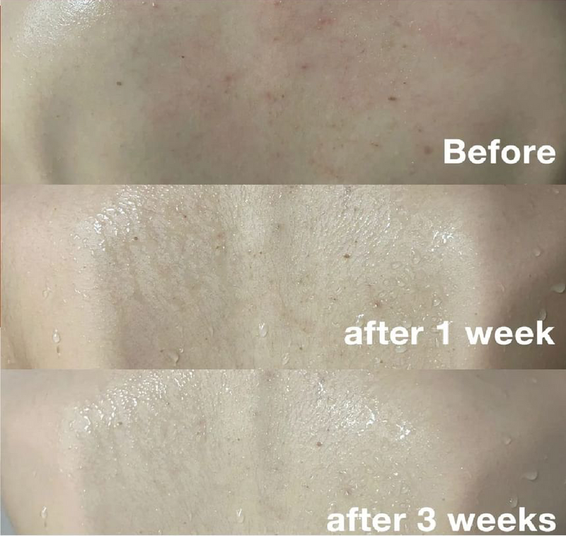 Medicube Red Acne Body Wash AHA BHA PHA Niacinamide 400 g