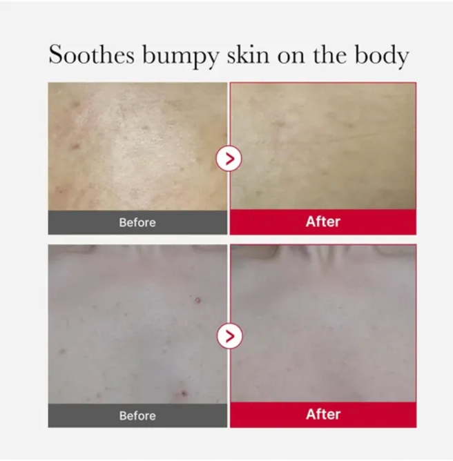 Medicube Red Acne Body Peeling Shot AHA BHA PHA LHA 110 g